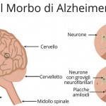 Alzheimer:  una nuova tecnologia ripristina la memoria.